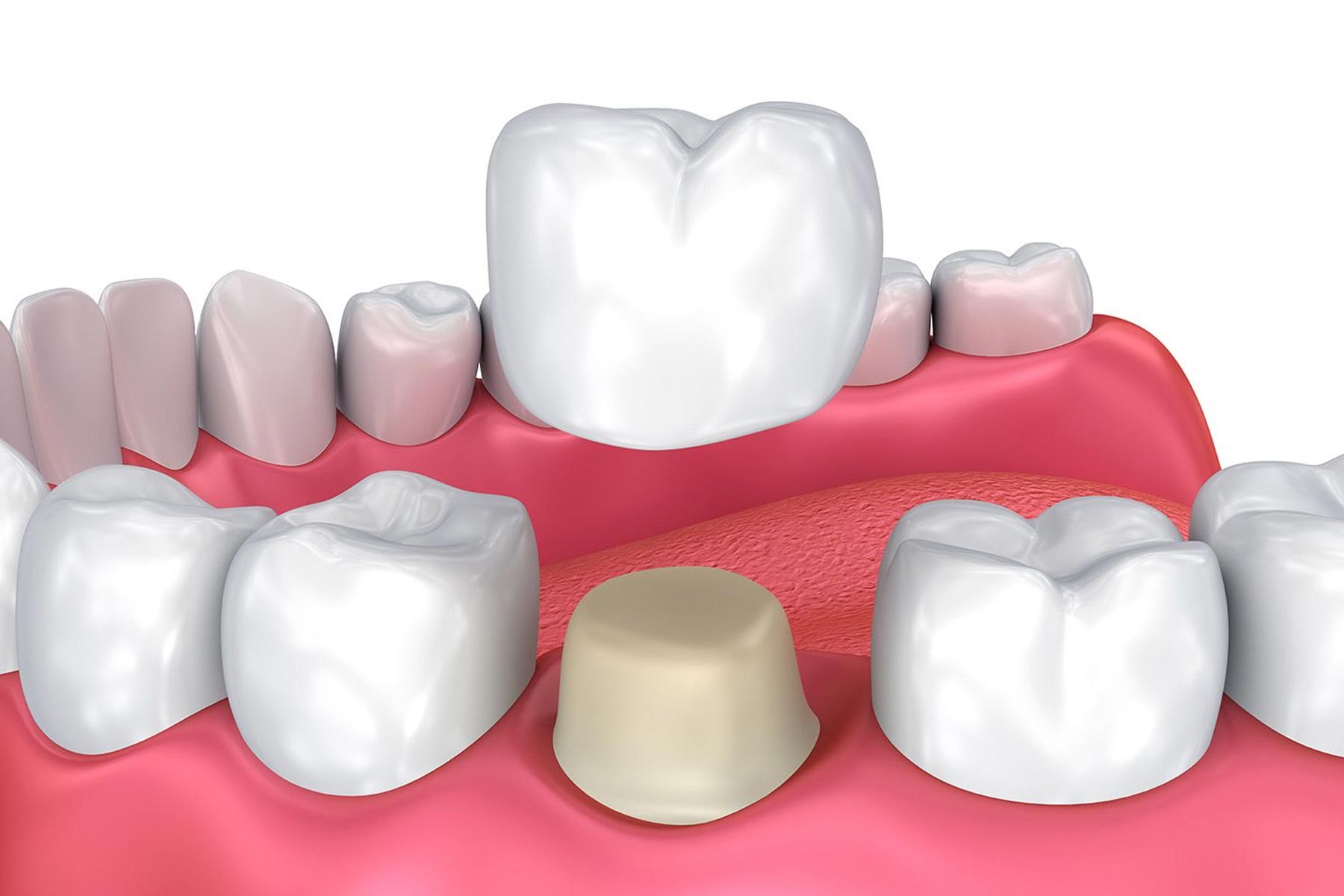 Dental crowns graphic showing up the crown fits into the mouth