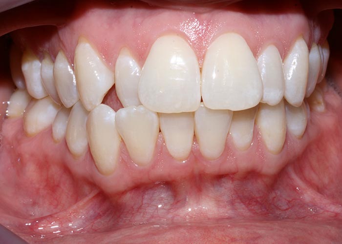 Before picture showing the crooked teeth of patients before orthodontic treatment